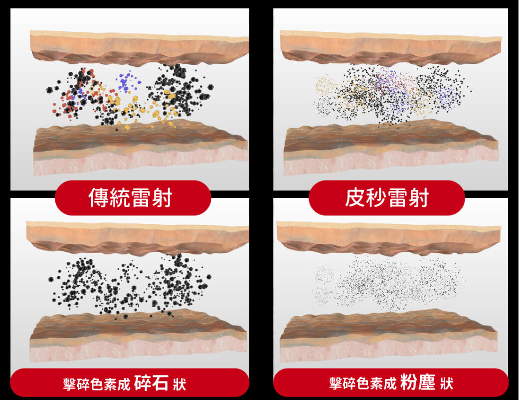 皮秒雷射震碎黑色素